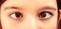 Strabismus. Little patient strabismus, treatment ophthalmic diseases. Strabismus in children causes, treatment concept