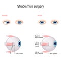 Strabismus Surgery. Eye muscle recession