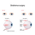 Strabismus Surgery. Hypertropia. Eye muscle recession