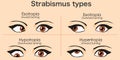 Strabismus types woman crossed eyes. Esotropia, inward turning, Outward, exotropia, Upward hypertropia, Downward hypotropia, Skin