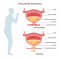 Stress urinary incontinence. Leakage of urine during moments of physical