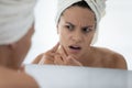 Stressed young hispanic latin woman suffering from acne. Royalty Free Stock Photo