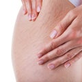 Stretch marks and cellulite Royalty Free Stock Photo