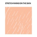 Stretch marks on the skin. Background stretch marks on the skin. Infographics. Vector illustration