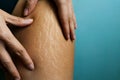 Fat Cellulite And Stretch Mark On Tan Skin Woman Leg At Home, Women Diet Styl Royalty Free Stock Photo