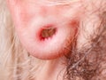 Stretched man ear after tunnel piercing Royalty Free Stock Photo