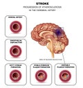 Stroke in the brain artery Royalty Free Stock Photo