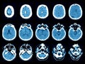 Stroke on computed tomography scans