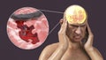 Stroke, conceptual illustration showing a man with acute headache and rupture of brain blood vessel