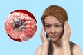 Stroke, conceptual illustration showing woman with acute headache and rupture of brain blood vessel