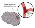 Stroke develope in human brains