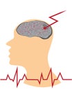 Stroke develope in human brains