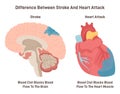 Stroke and heart attack. Plaque develops on the inside of the blood vessel