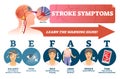 Stroke symptoms vector illustration. Signs of sudden blood clot in head.