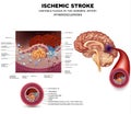 Stroke and thrombus Royalty Free Stock Photo