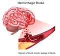 Stroke types poster, banner. Vector medical illustration. white background, anatomy image of damaged human brain Royalty Free Stock Photo