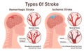 Stroke types set. Hemorrhagic and ischemic brain stroke. Damaged human Royalty Free Stock Photo