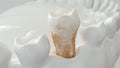 Strong plaque on a molar tooth - 3D Rendering