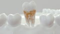 Strong plaque on a molar tooth - 3D Rendering