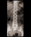 strong spine on x-ray Royalty Free Stock Photo