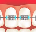 The structure of the braces. Orthodontics. Infographics. Vector illustration. Royalty Free Stock Photo