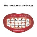 The structure of the braces. Orthodontics. Infographics. Vector illustration on isolated background Royalty Free Stock Photo