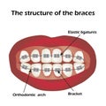 The structure of the braces. Orthodontics. Infographics. Vector illustration on isolated background Royalty Free Stock Photo