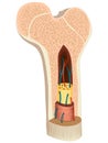 Structure and composition of a long bone. Diagram of Cross section of a human bone showing bone marrow, spongy bone and