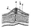 Structure of corns and pithy calluses.