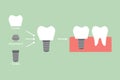 Structure of the dental implant with all parts disassembled, crown, abutment, - compare with strong tooth