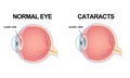 The structure of the eye. Cataract