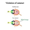 The structure of the eye. Cataracts. As the