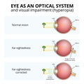 structure of the eyeball, visual impairment, farsightedness Royalty Free Stock Photo