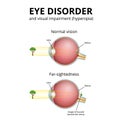 structure of the eyeball, visual impairment, farsightedness Royalty Free Stock Photo