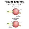structure of the eyeball, visual impairment, farsightedness Royalty Free Stock Photo