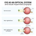 structure of the eyeball, visual impairment, near-sightedness Royalty Free Stock Photo