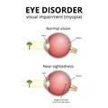 structure of the eyeball, visual impairment, near-sightedness Royalty Free Stock Photo