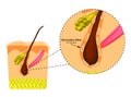 The structure of the hair. Sebaceous gland. Introduction of demodex mite. Demodecosis. Infographics. Vector illustration Royalty Free Stock Photo