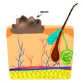 The structure of the nevus. The structure of moles on the skin. Infographics. Vector illustration