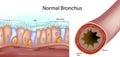 Structure of a normal human bronchus. Cross-section of the airway and a close-up of the pseudostratified ciliated epithelium with Royalty Free Stock Photo