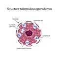 The structure of tuberculous granulomas. Vector illustration on background