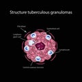 The structure of tuberculous granulomas. Vector illustration