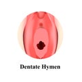 The structure of the vulva hymen Denticular. Hymen after defloration. Female genital organs. Infographics. Vector Royalty Free Stock Photo