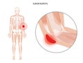 Student elbow bursitis