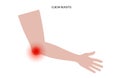 Student elbow bursitis