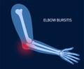 Student elbow bursitis