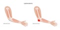 Student elbow bursitis