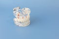 Study Standard Typodont or Periodontal Disease Teeth Model for Laboratory Teaching on Blue Royalty Free Stock Photo