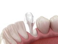 Stump pin tab on canaine tooth. Medically accurate dental 3D illustration