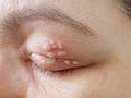 A stye is a bacterial infection involving one or more of the small glands near the base of your eyelashes. It is similar to a boil